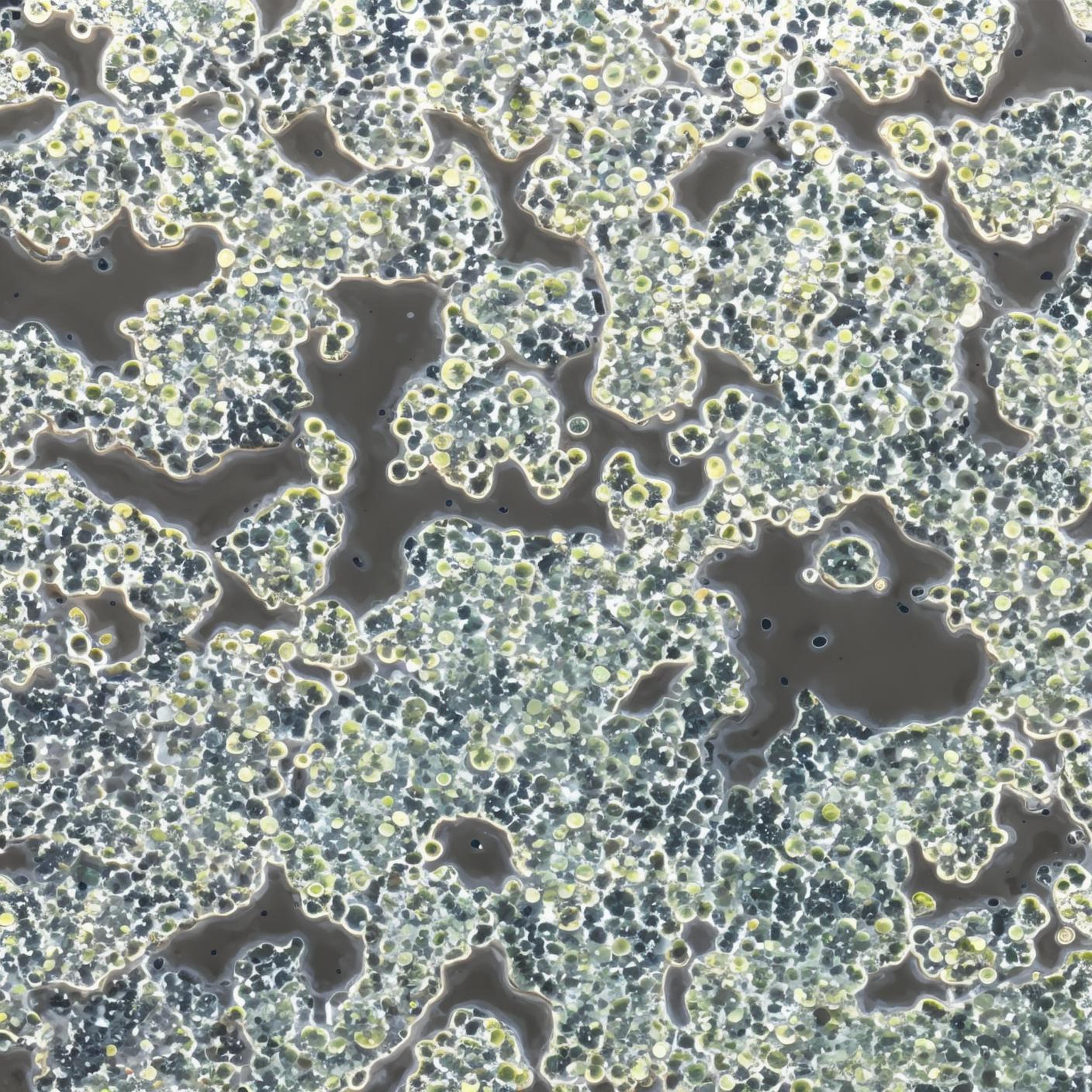 small cell carcinoma liver cancer​